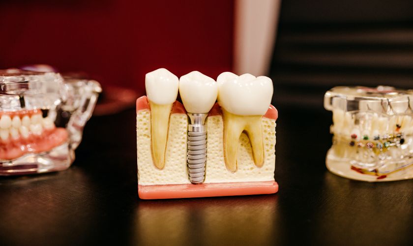 The Importance of Dental Implants for Oral Health