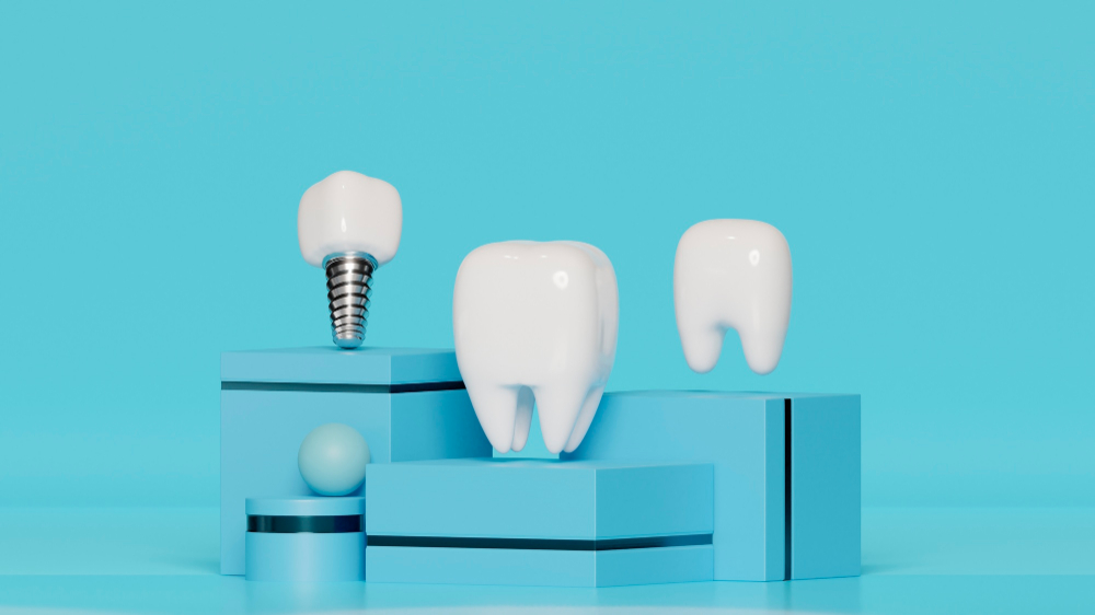 The Importance of Dental Implants for Oral Health