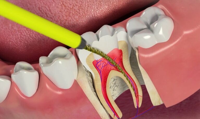 Breathtaking Can Antibiotics Heal An Infected Root Canal Landscape Photography Breathtaking Can Antibiotics Heal An Infected Root Canal Landscape Photography